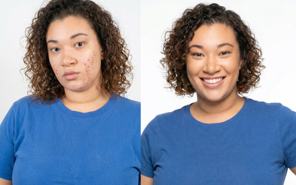 Clear Skin / Acne